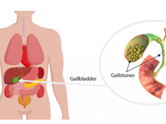 gallstones