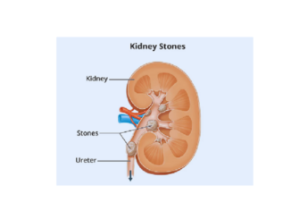 kidney stones