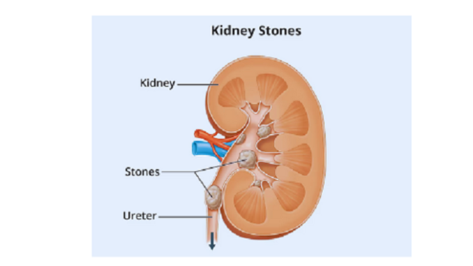 kidney stones