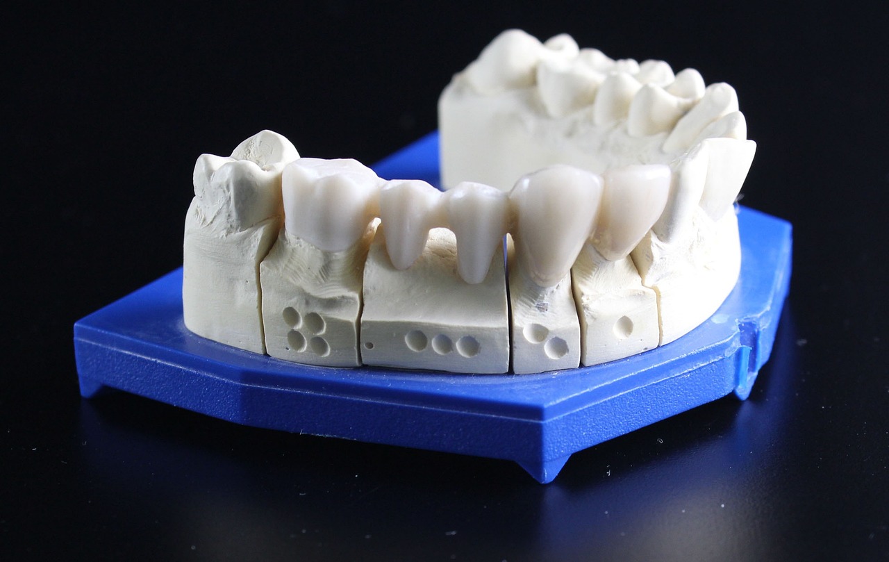 BridgeWork Teeth