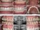 Bridgework Teeth